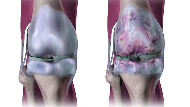 Kniegelenk gesund und von Arthrose betroffen
