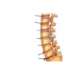 Symptome der Osteochondrose