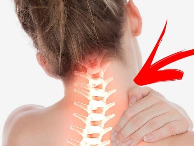 Kompression der Nervenwurzeln mit zervikaler Osteochondose