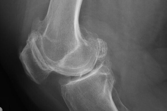 Methoden zur Diagnose der Kniearthrose