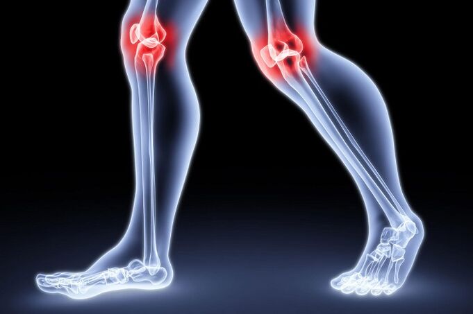 Knieschmerzen aufgrund von Arthritis und Arthrose