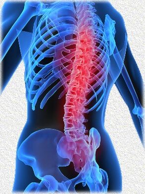 Osteochondrose und Methoden ihrer Behandlung